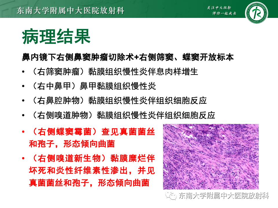 影像PPT - 【PPT】鼻颅底病变随访-76