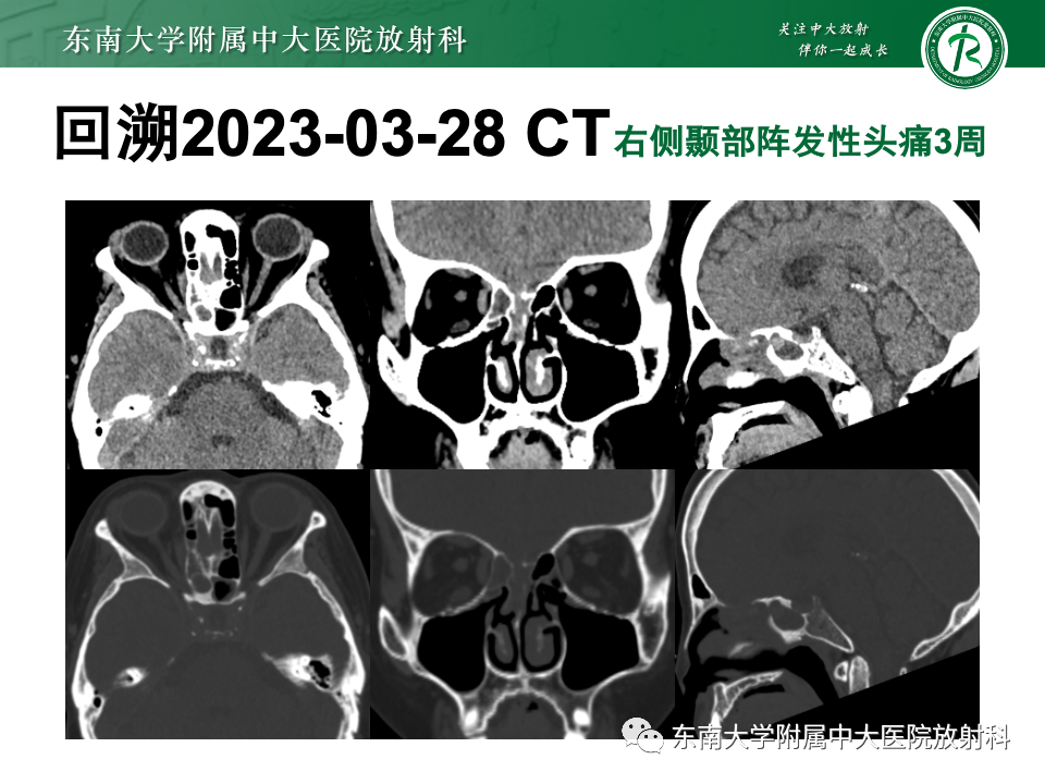 影像PPT - 【PPT】鼻颅底病变随访-77