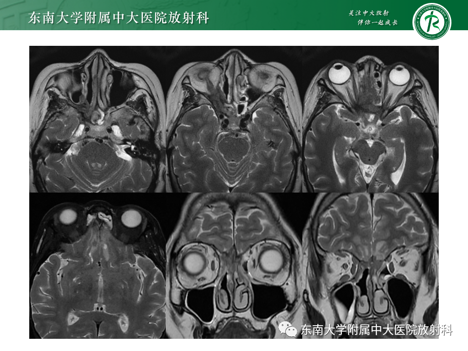 影像PPT - 【PPT】鼻颅底病变随访-79