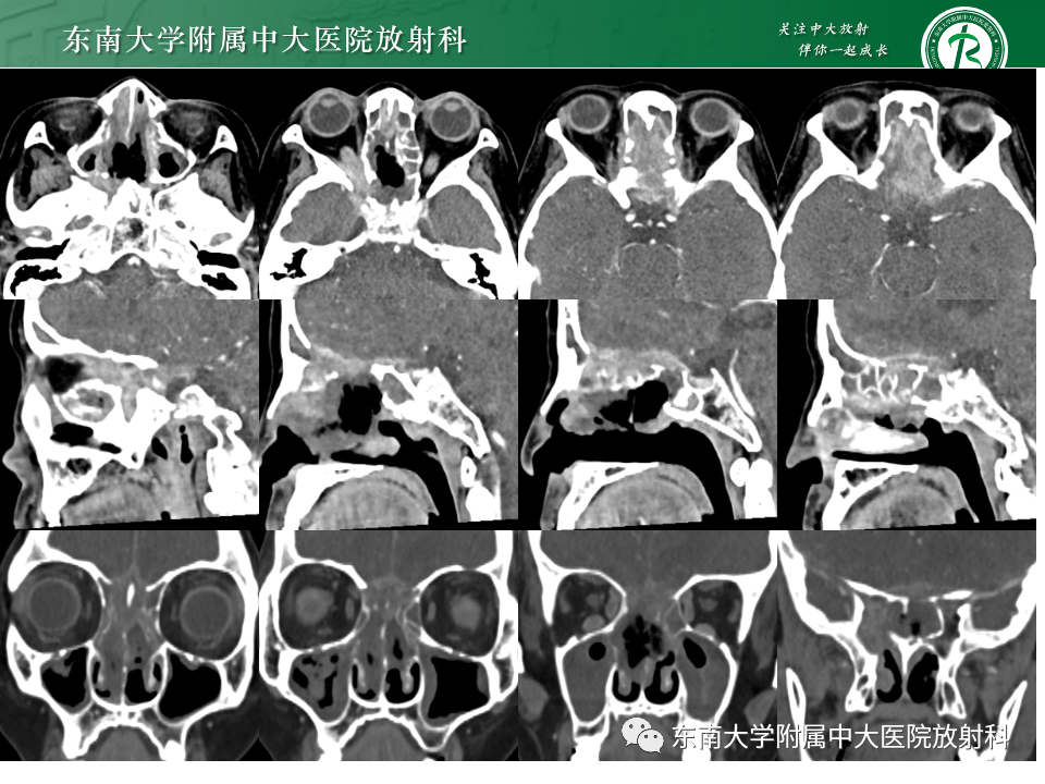 影像PPT - 【PPT】鼻颅底病变随访-81