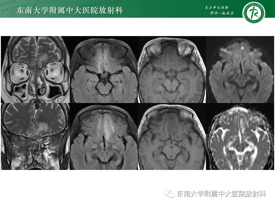 影像PPT - 【PPT】鼻颅底病变随访-82