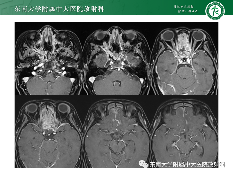 影像PPT - 【PPT】鼻颅底病变随访-84
