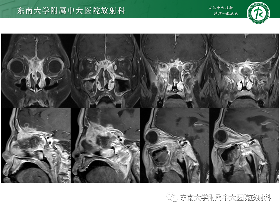 影像PPT - 【PPT】鼻颅底病变随访-85