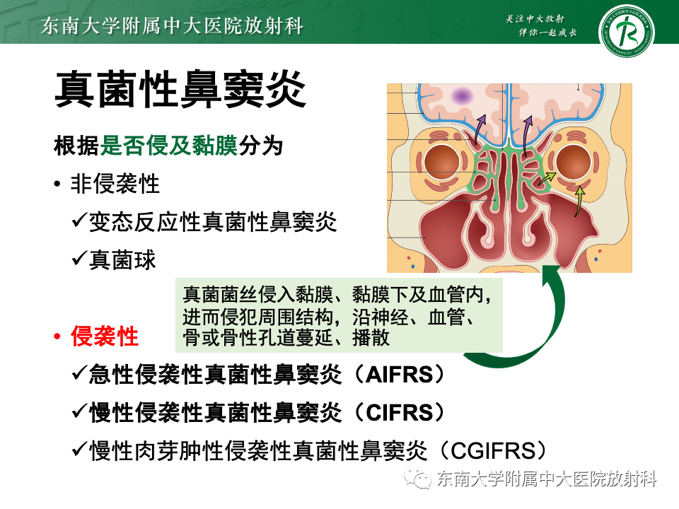 影像PPT - 【PPT】鼻颅底病变随访-87