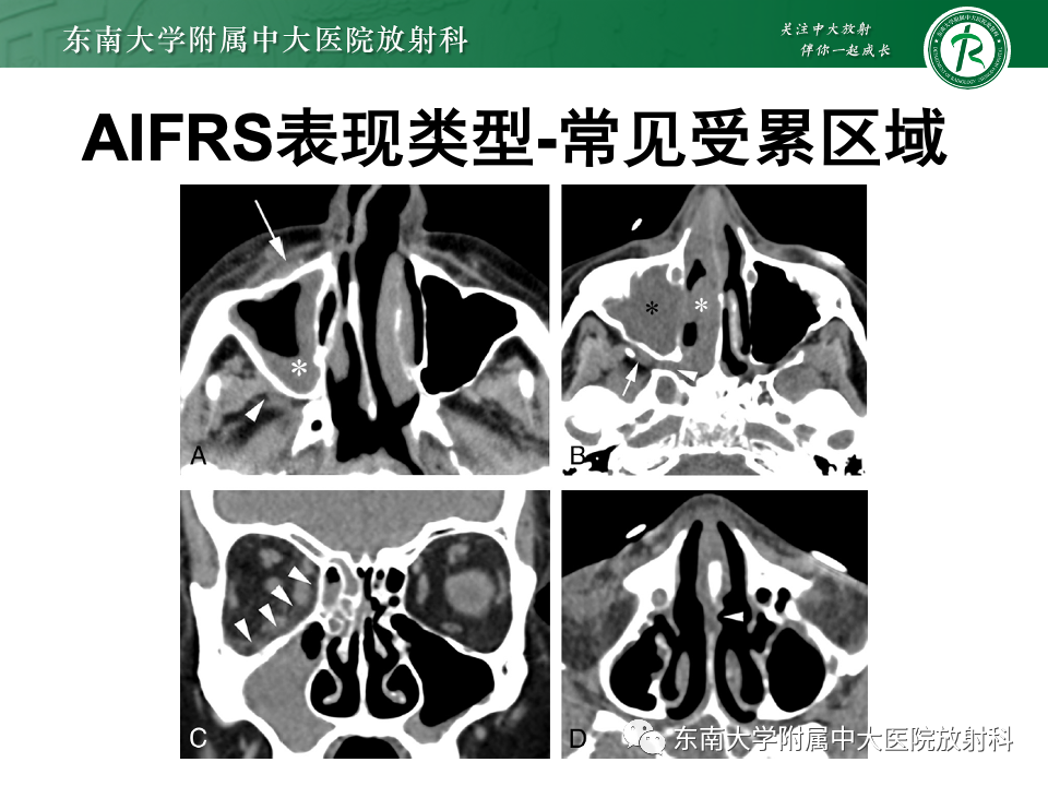 影像PPT - 【PPT】鼻颅底病变随访-92