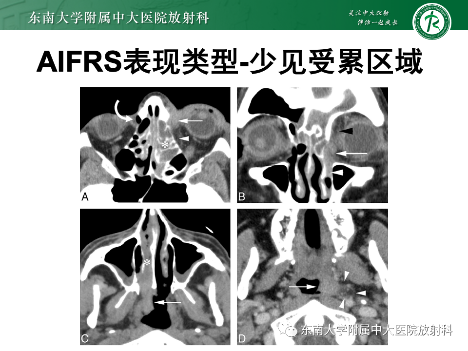 影像PPT - 【PPT】鼻颅底病变随访-93