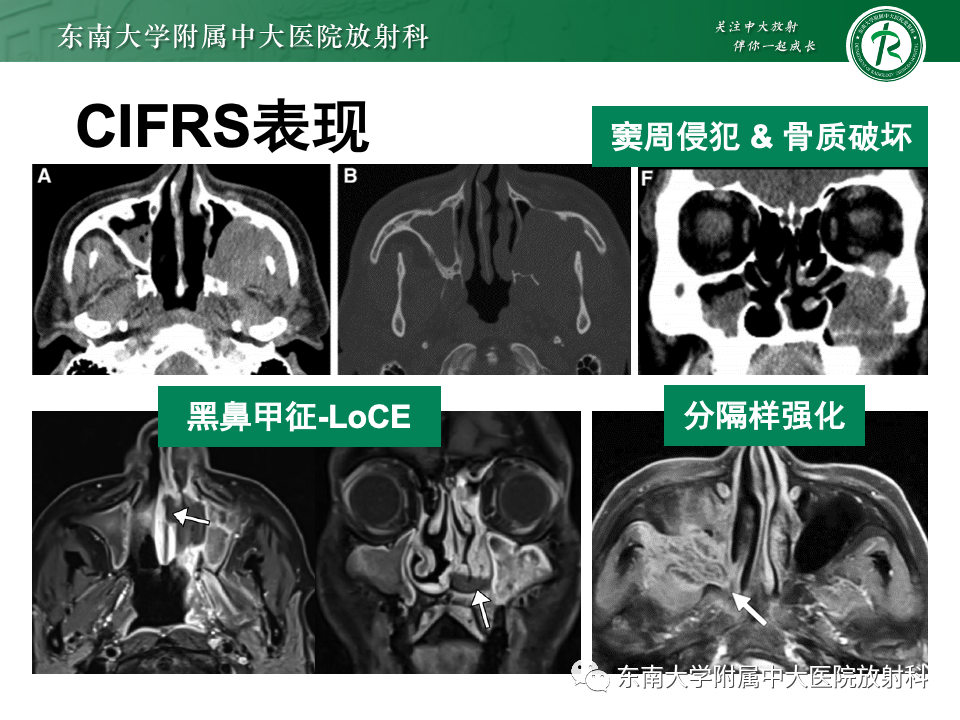 影像PPT - 【PPT】鼻颅底病变随访-94