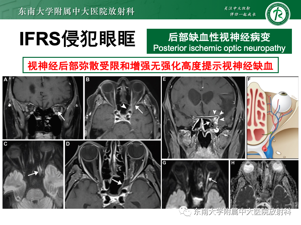 影像PPT - 【PPT】鼻颅底病变随访-95