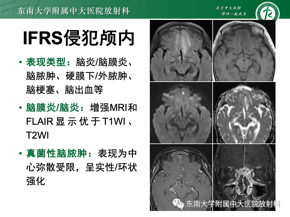 影像PPT - 【PPT】鼻颅底病变随访-96
