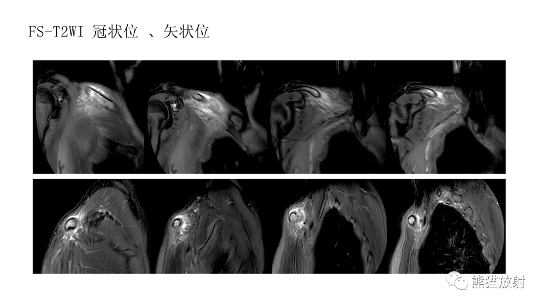 影像PPT - 【病例】锁骨嗜酸性肉芽肿/朗格汉斯组织细胞增生症2例CT及MR影像-6