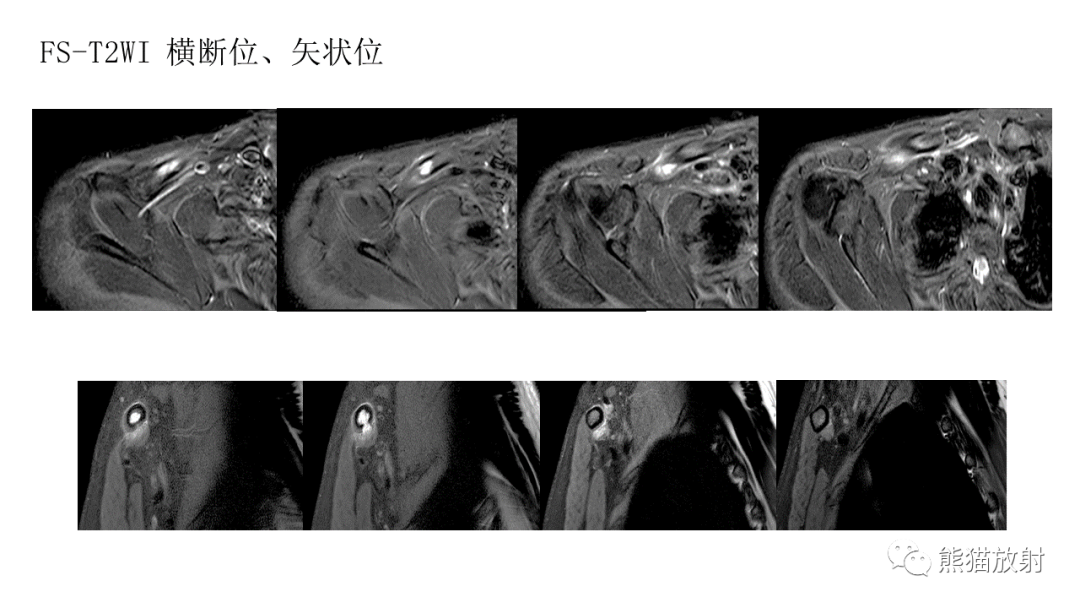 影像PPT - 【病例】锁骨嗜酸性肉芽肿/朗格汉斯组织细胞增生症2例CT及MR影像-13