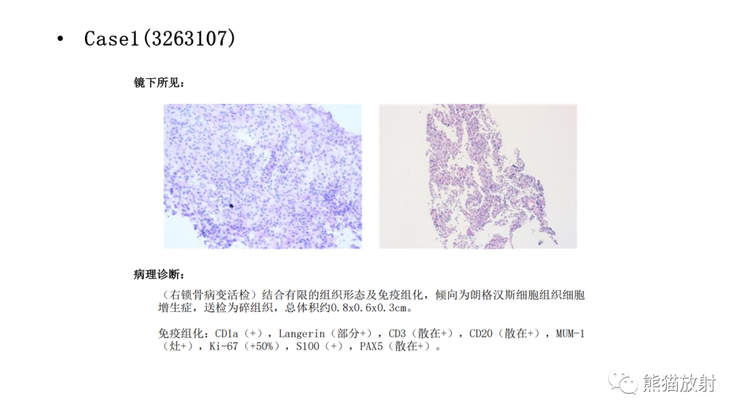 影像PPT - 【病例】锁骨嗜酸性肉芽肿/朗格汉斯组织细胞增生症2例CT及MR影像-14