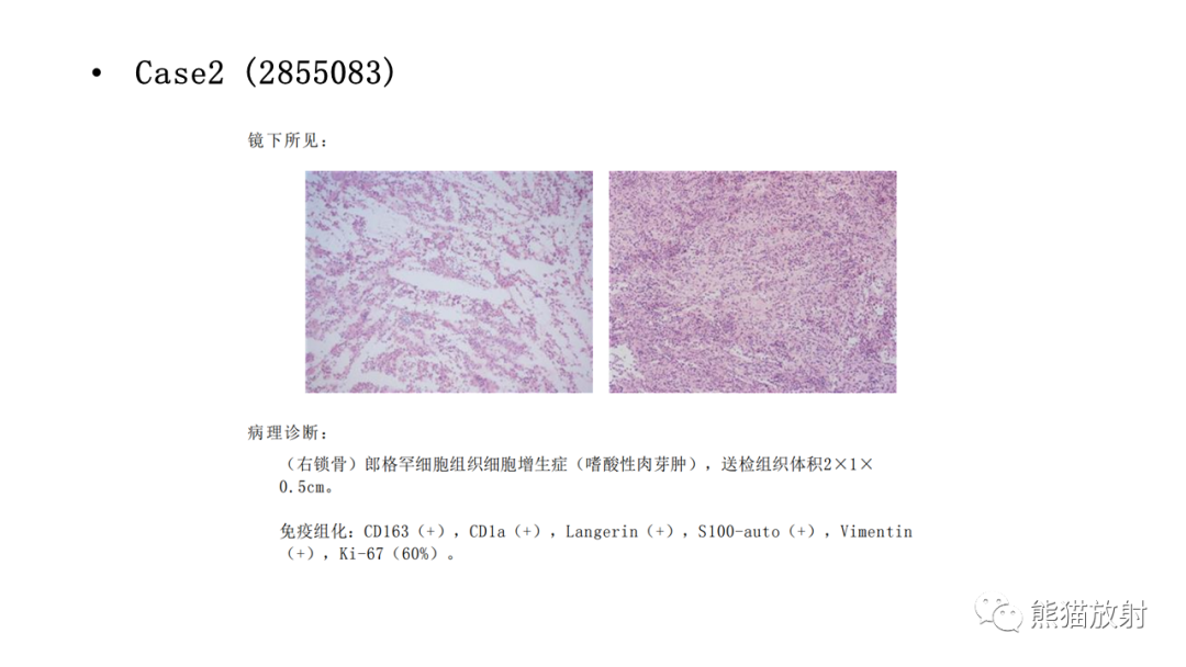 影像PPT - 【病例】锁骨嗜酸性肉芽肿/朗格汉斯组织细胞增生症2例CT及MR影像-15