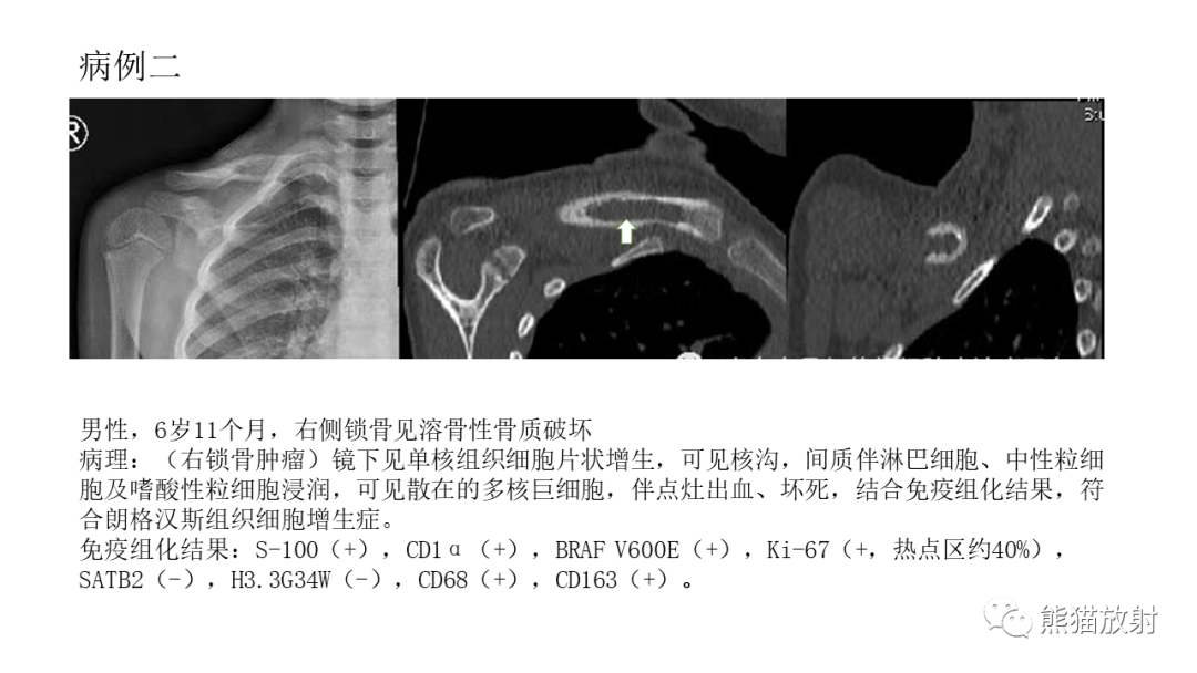 影像PPT - 【病例】锁骨嗜酸性肉芽肿/朗格汉斯组织细胞增生症2例CT及MR影像-22