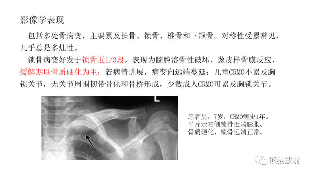 影像PPT - 【病例】锁骨嗜酸性肉芽肿/朗格汉斯组织细胞增生症2例CT及MR影像-24