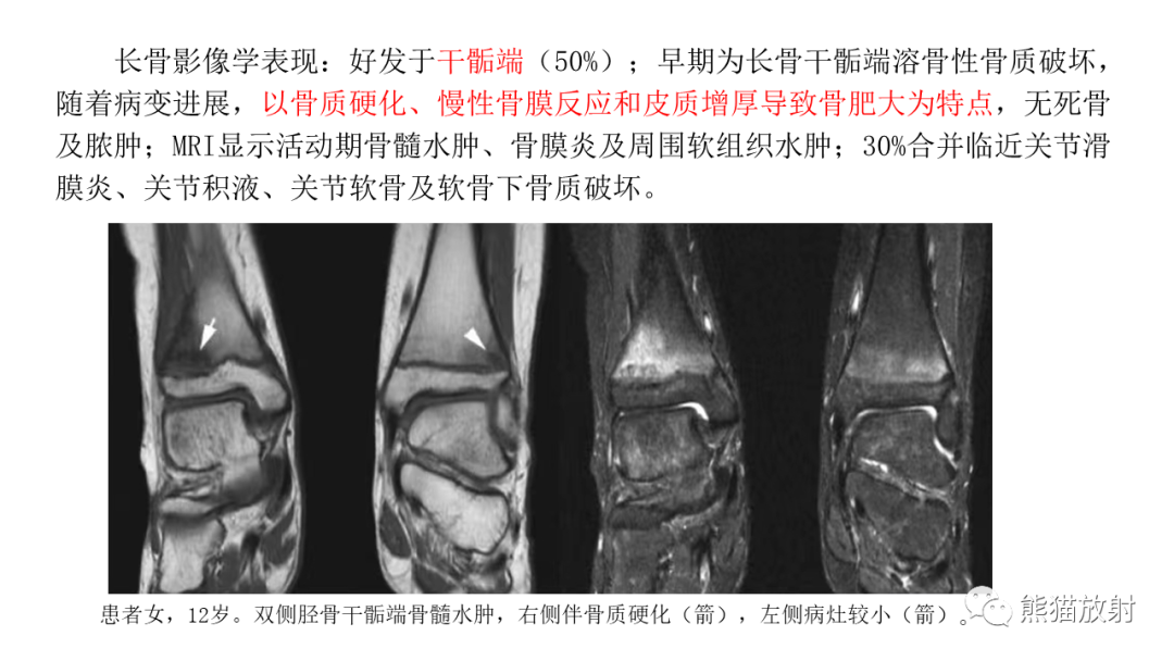 影像PPT - 【病例】锁骨嗜酸性肉芽肿/朗格汉斯组织细胞增生症2例CT及MR影像-26
