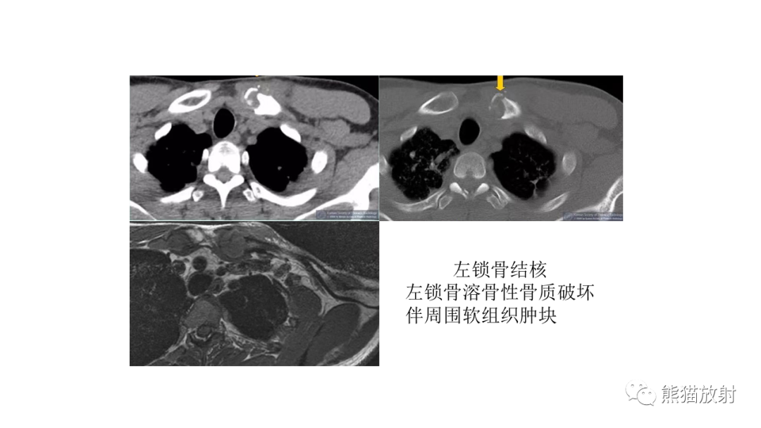 影像PPT - 【病例】锁骨嗜酸性肉芽肿/朗格汉斯组织细胞增生症2例CT及MR影像-28