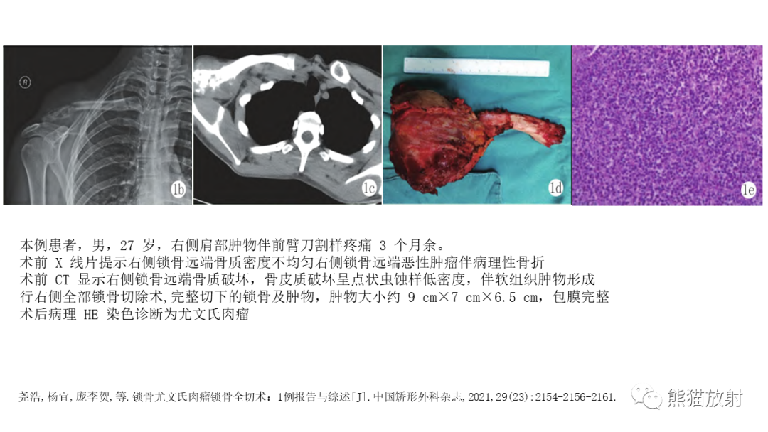 影像PPT - 【病例】锁骨嗜酸性肉芽肿/朗格汉斯组织细胞增生症2例CT及MR影像-31