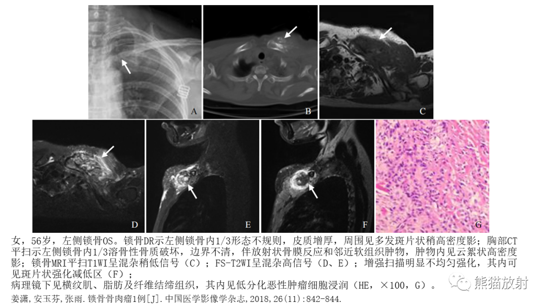 影像PPT - 【病例】锁骨嗜酸性肉芽肿/朗格汉斯组织细胞增生症2例CT及MR影像-34