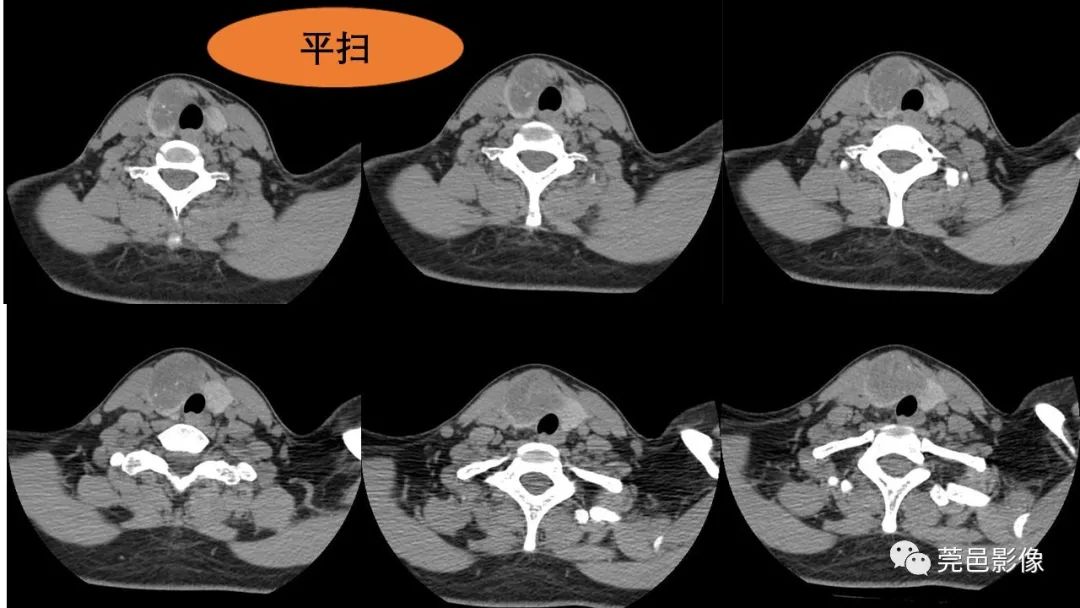 影像PPT - 【PPT】甲状腺乳头状癌影像诊断与鉴别诊断-6
