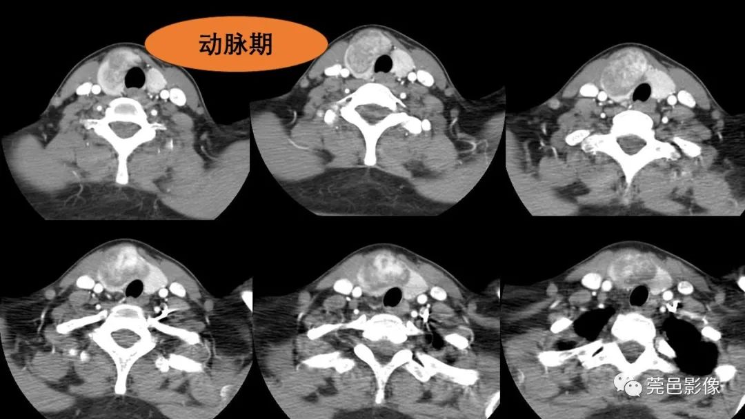影像PPT - 【PPT】甲状腺乳头状癌影像诊断与鉴别诊断-7