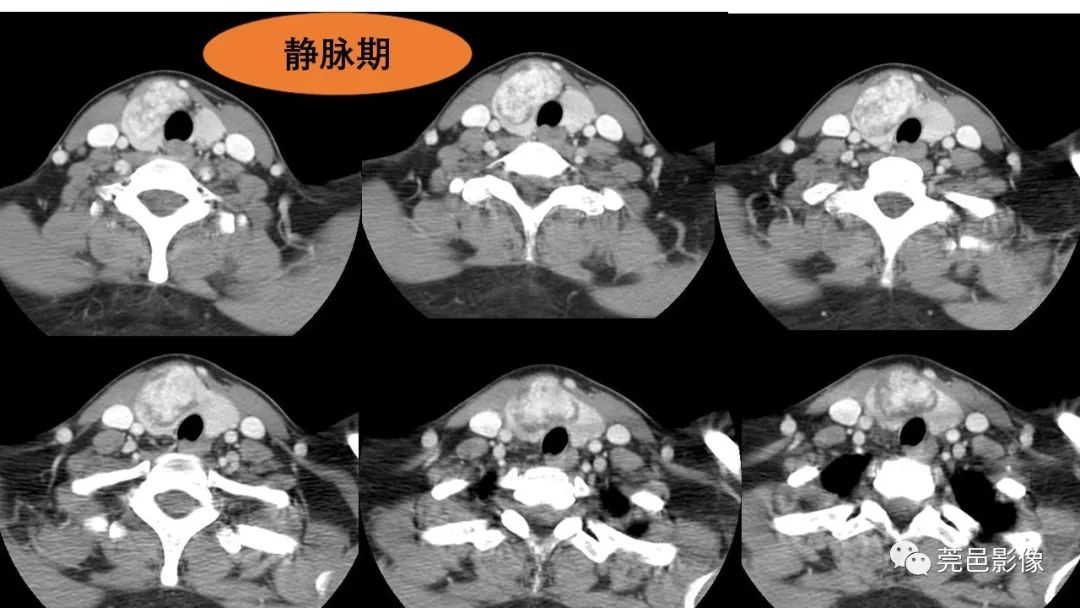 影像PPT - 【PPT】甲状腺乳头状癌影像诊断与鉴别诊断-8