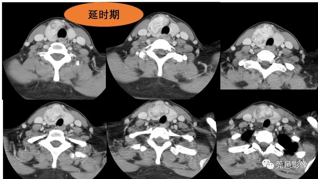 影像PPT - 【PPT】甲状腺乳头状癌影像诊断与鉴别诊断-9