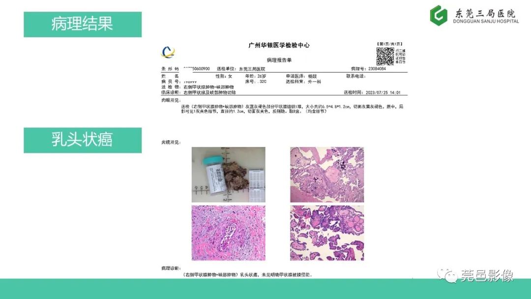 影像PPT - 【PPT】甲状腺乳头状癌影像诊断与鉴别诊断-11