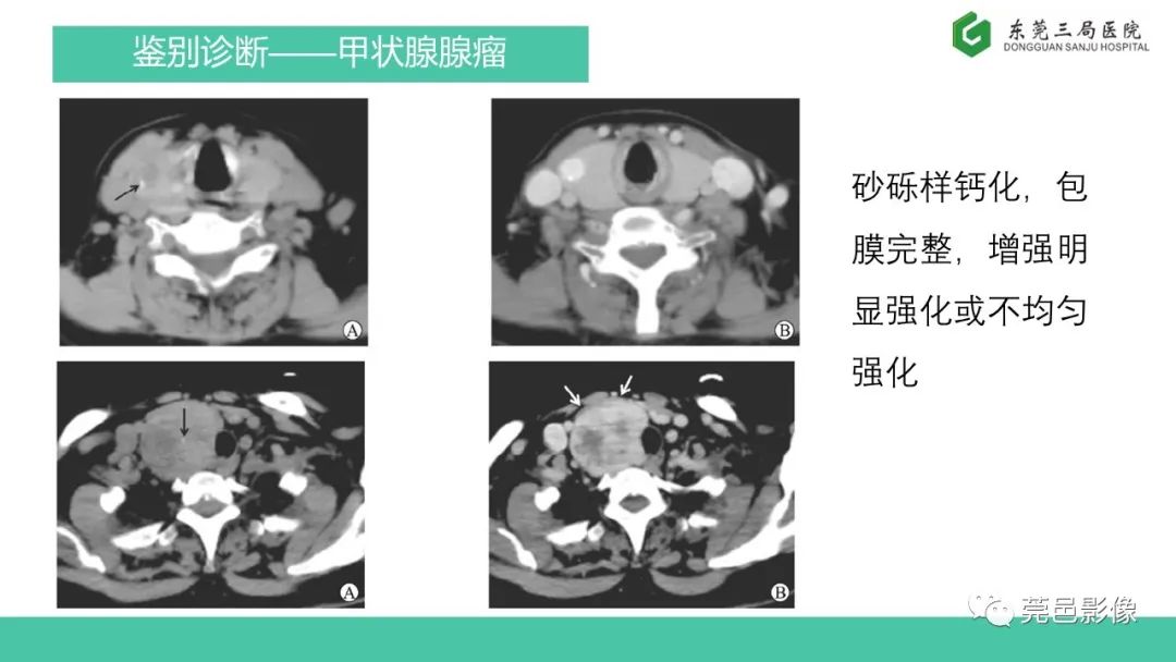 影像PPT - 【PPT】甲状腺乳头状癌影像诊断与鉴别诊断-20