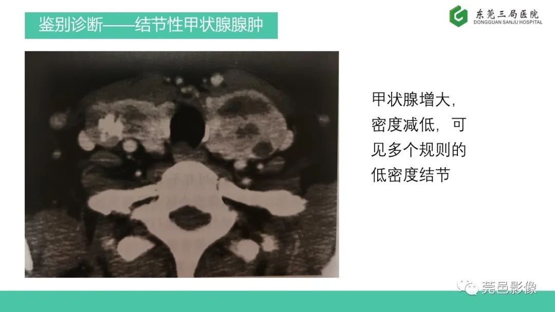 影像PPT - 【PPT】甲状腺乳头状癌影像诊断与鉴别诊断-22
