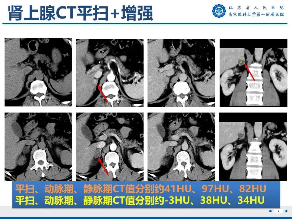影像PPT - 【PPT】原发性醛固酮增多症-3