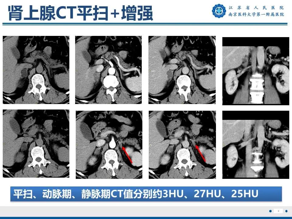 影像PPT - 【PPT】原发性醛固酮增多症-4