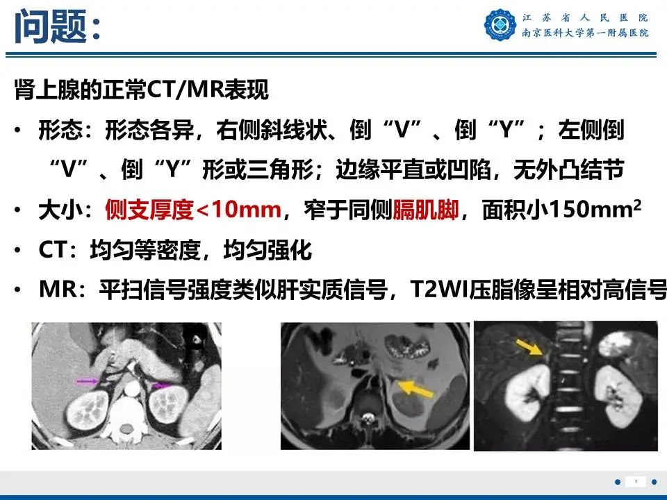影像PPT - 【PPT】原发性醛固酮增多症-8