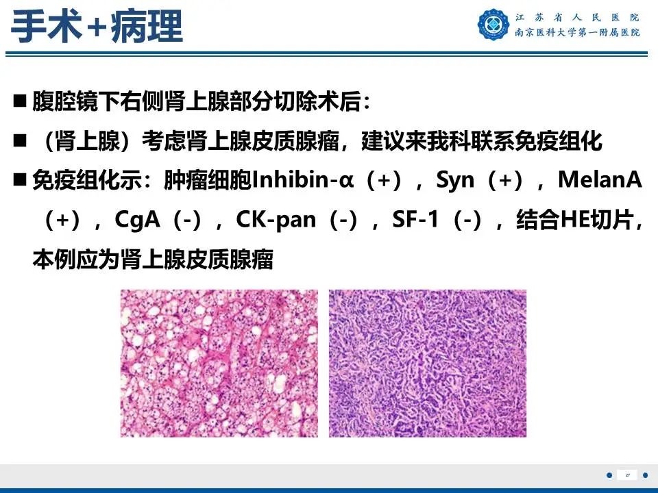 影像PPT - 【PPT】原发性醛固酮增多症-28