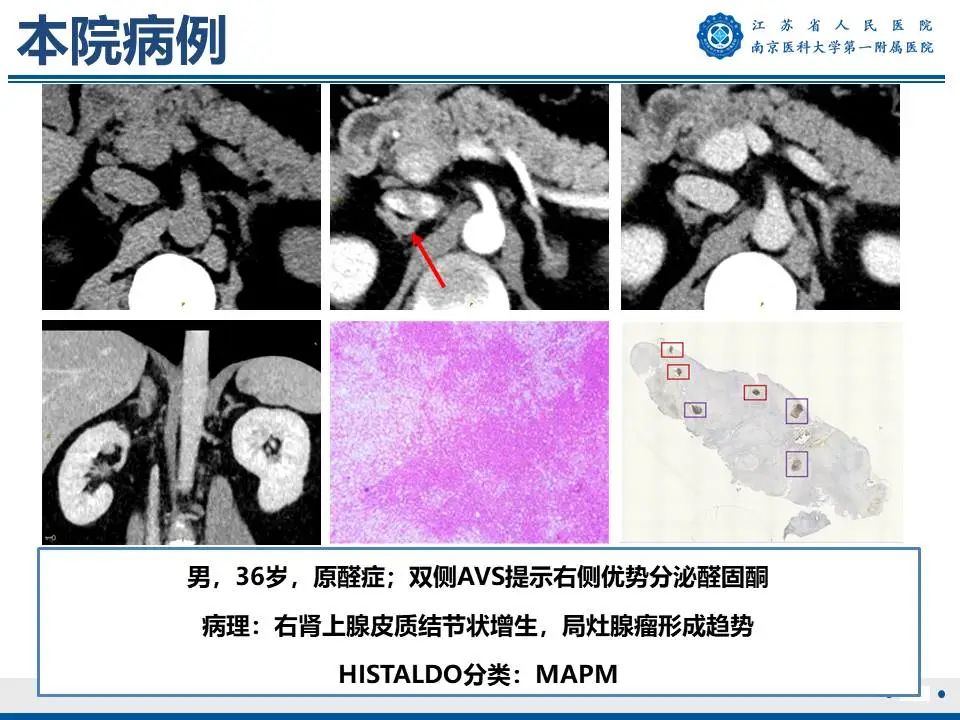 影像PPT - 【PPT】原发性醛固酮增多症-41