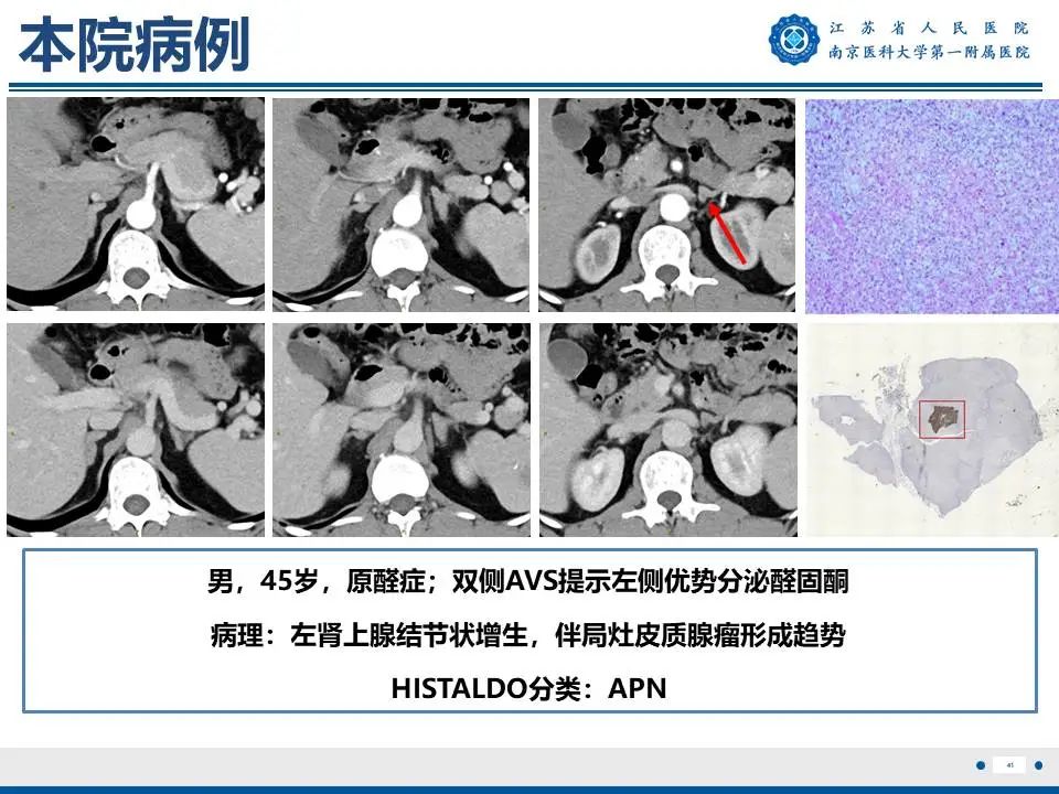 影像PPT - 【PPT】原发性醛固酮增多症-42
