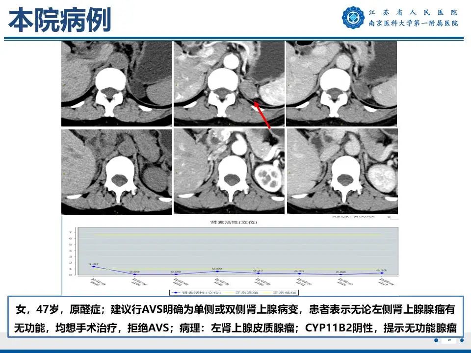 影像PPT - 【PPT】原发性醛固酮增多症-43
