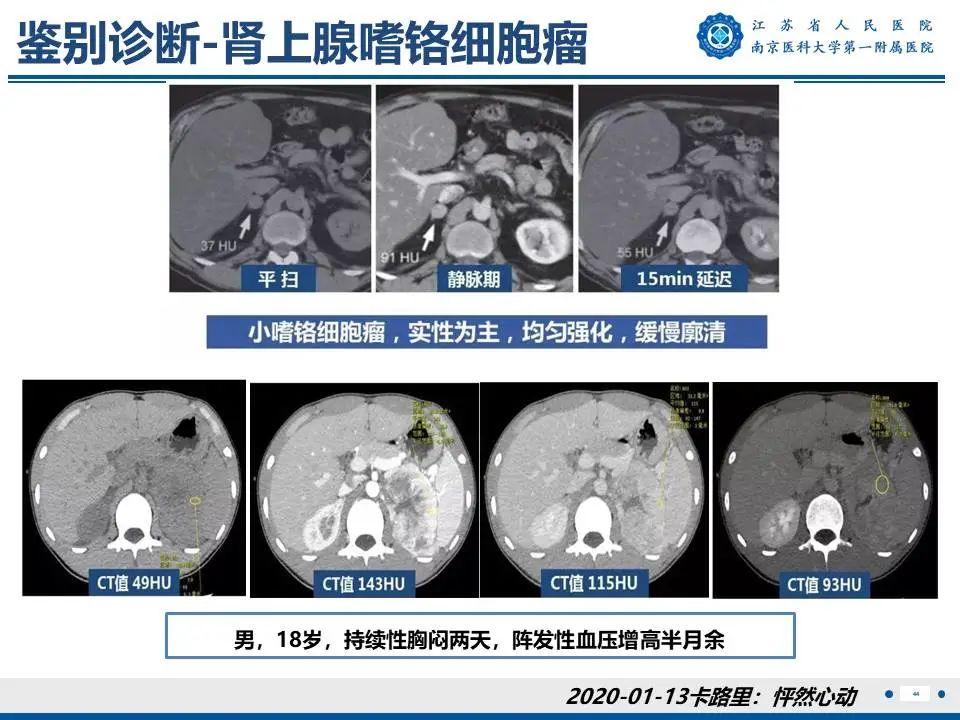 影像PPT - 【PPT】原发性醛固酮增多症-45