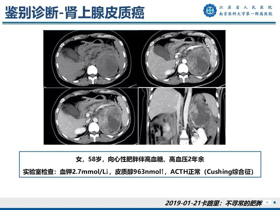 影像PPT - 【PPT】原发性醛固酮增多症-46