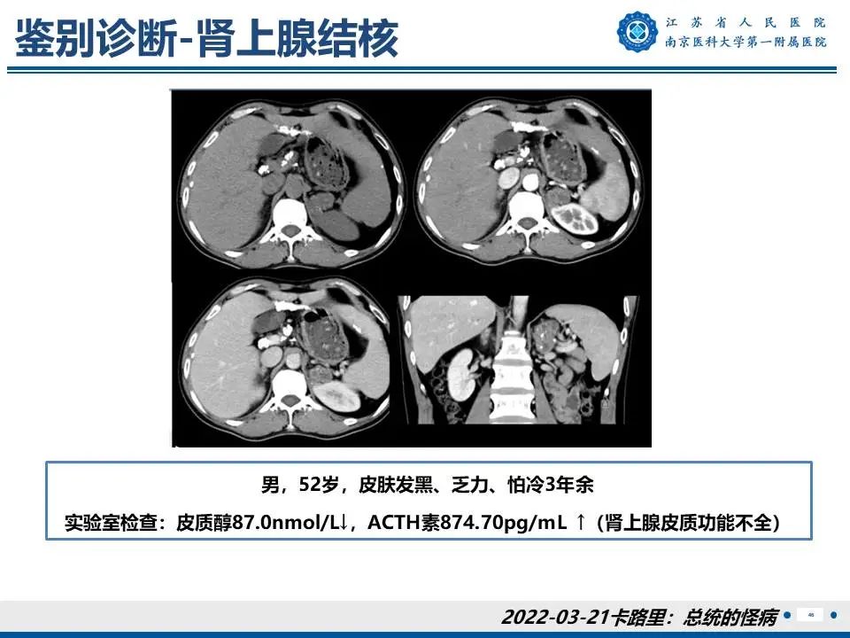影像PPT - 【PPT】原发性醛固酮增多症-47