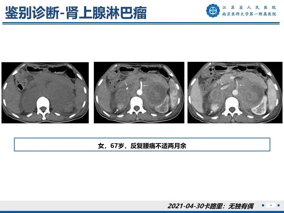 影像PPT - 【PPT】原发性醛固酮增多症-49