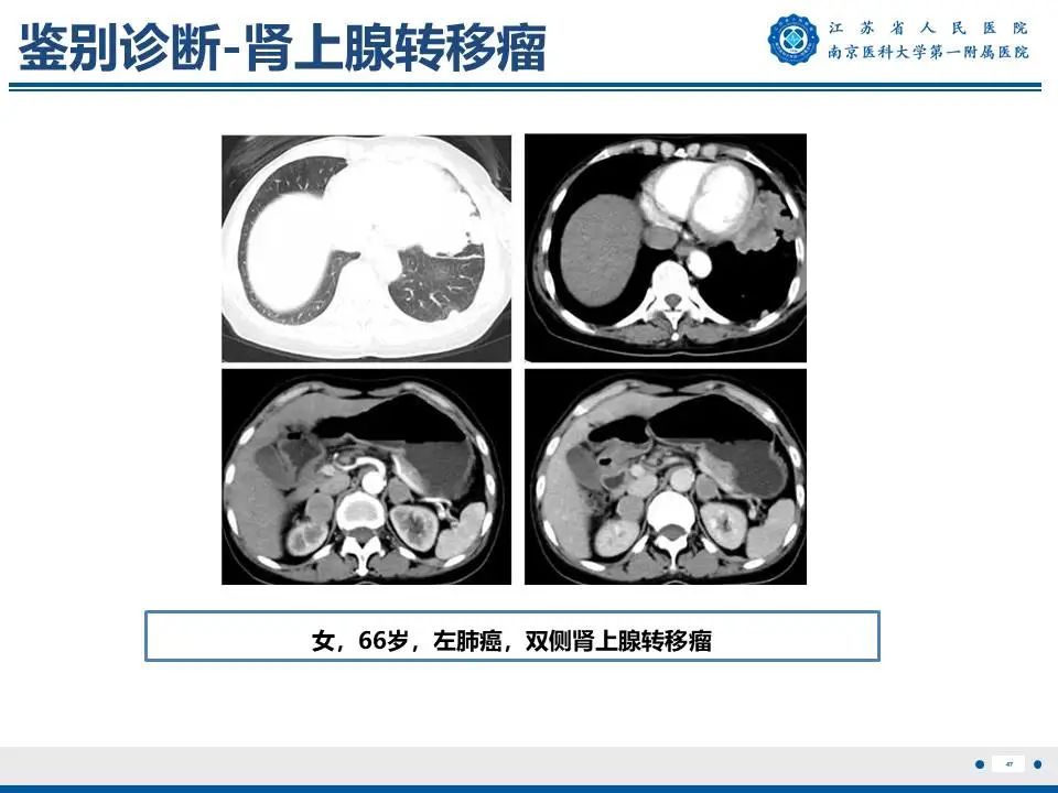 影像PPT - 【PPT】原发性醛固酮增多症-48