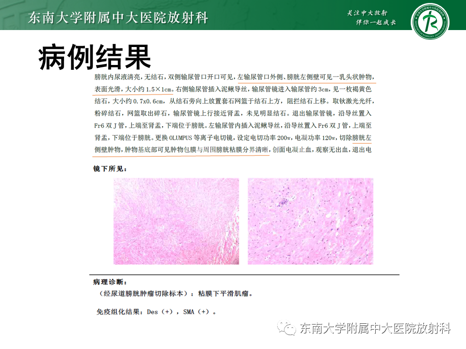 影像PPT - 【PPT】膀胱平滑肌瘤-1