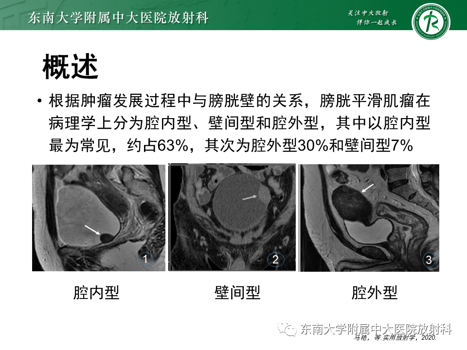 影像PPT - 【PPT】膀胱平滑肌瘤-9
