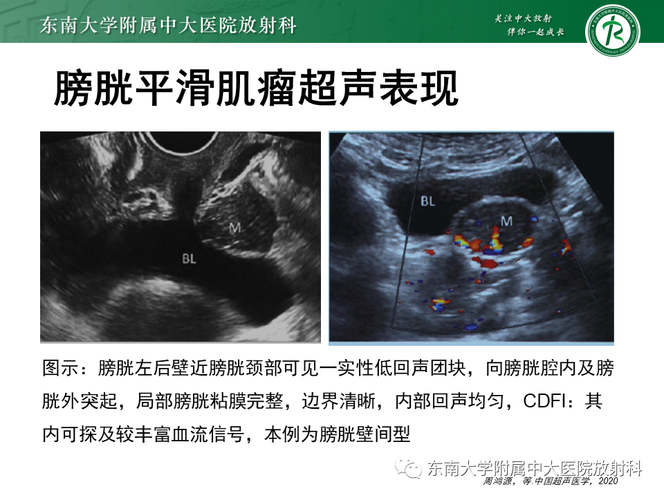 影像PPT - 【PPT】膀胱平滑肌瘤-11