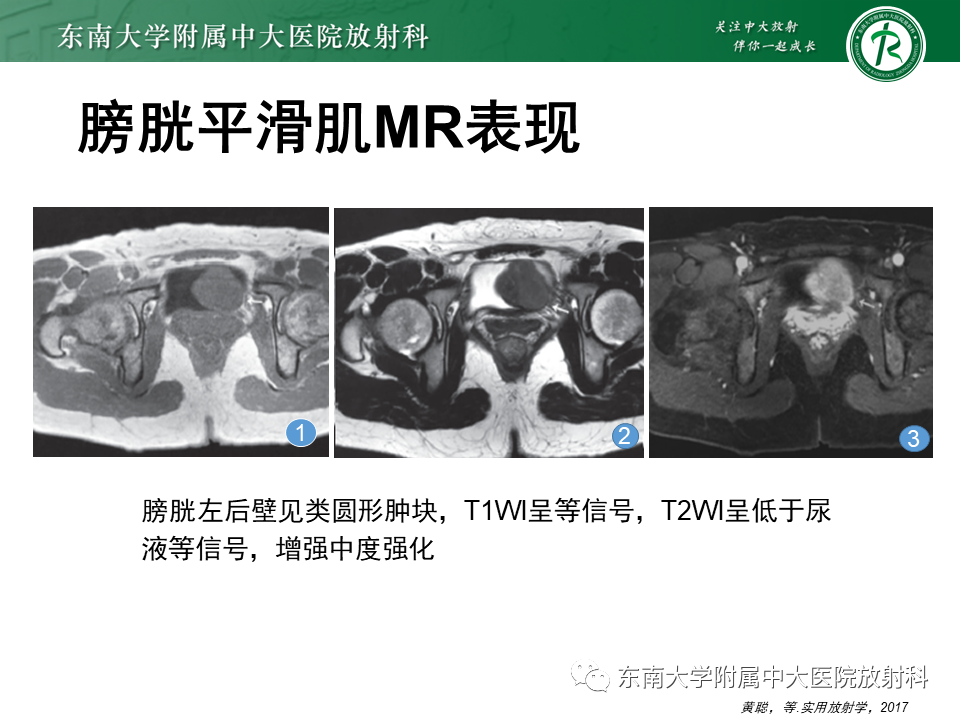 影像PPT - 【PPT】膀胱平滑肌瘤-12