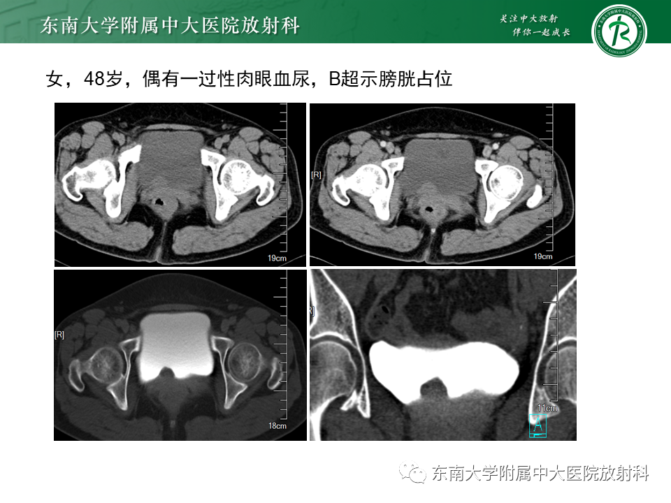 影像PPT - 【PPT】膀胱平滑肌瘤-13