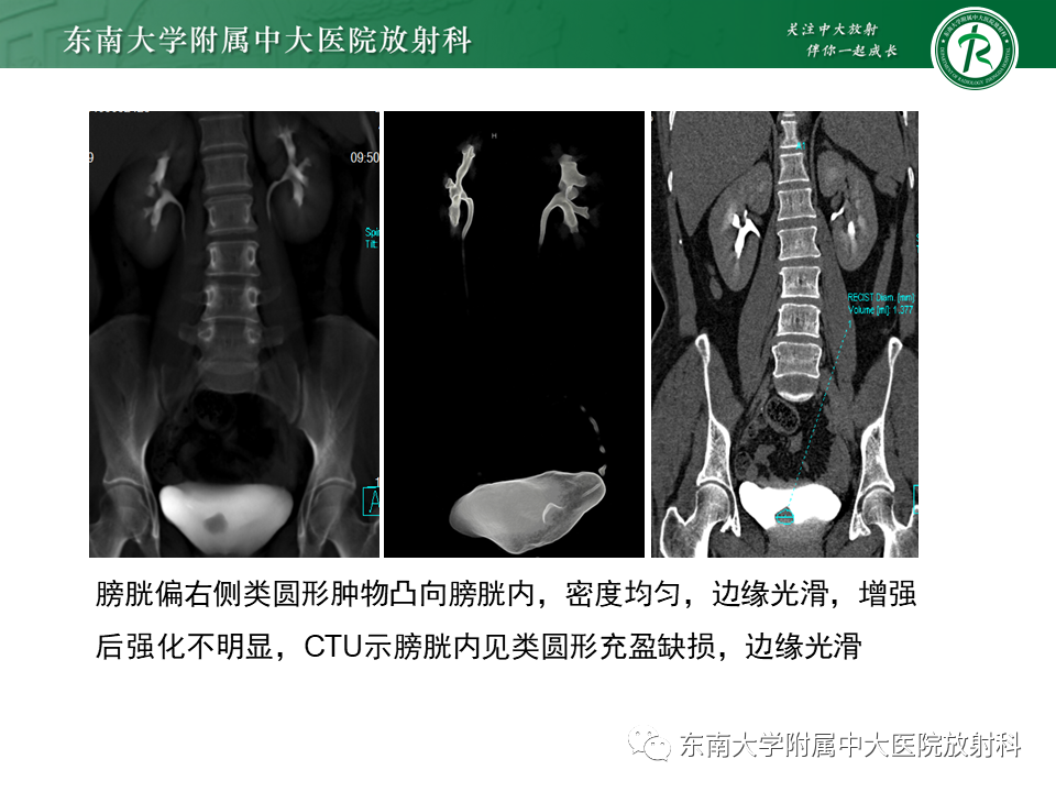 影像PPT - 【PPT】膀胱平滑肌瘤-14