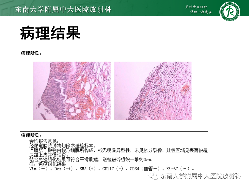 影像PPT - 【PPT】膀胱平滑肌瘤-15