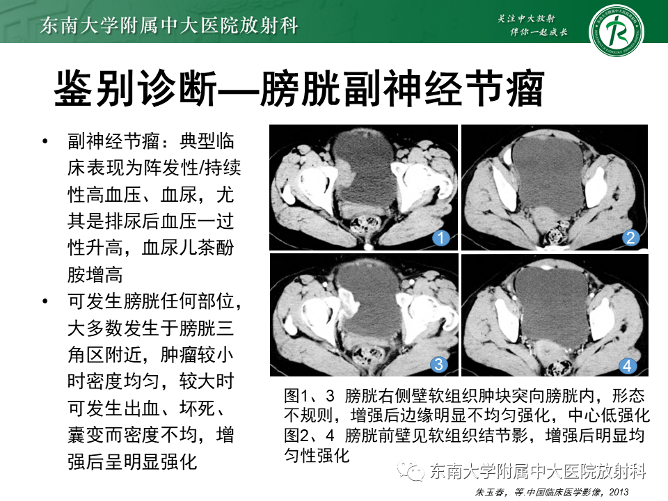 影像PPT - 【PPT】膀胱平滑肌瘤-17